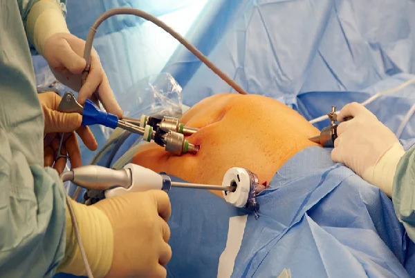Bariatric Surgery